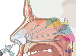 Endoscopic Anterior Skull Base Surgery